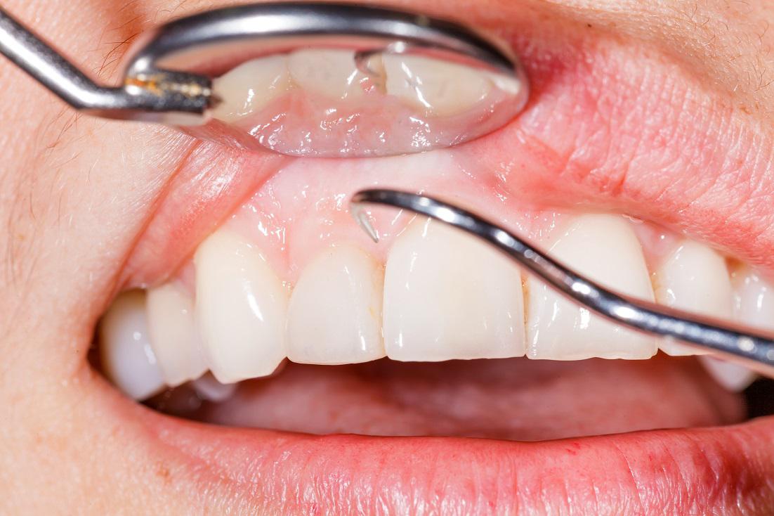 5 Tips To Prevent Gum Disease & Treatment Options