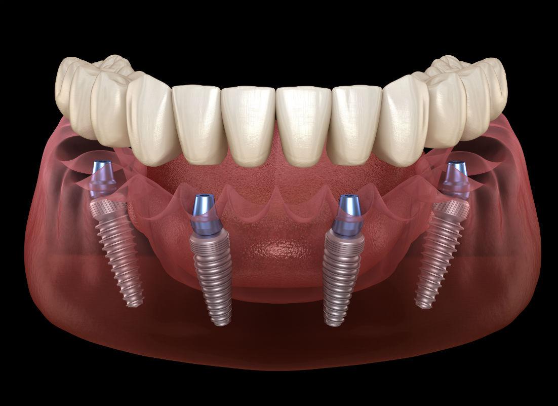 All On 4 Implants Frederick & Gaithersburg, MD