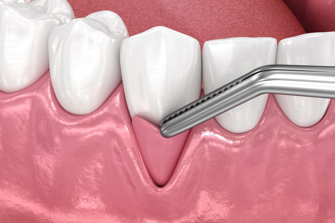 Gum Grafting vs. Soft Tissue Grafting