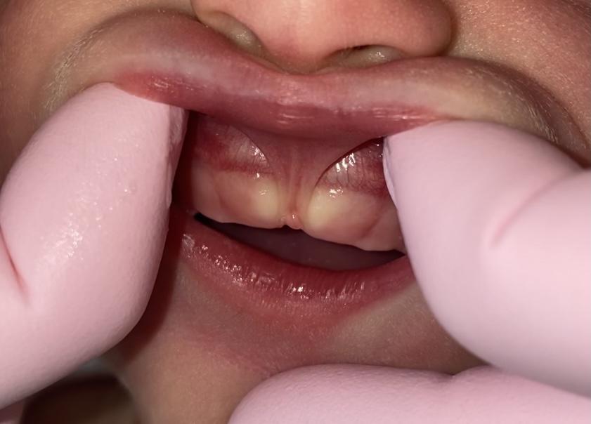 Lip Tie, MD