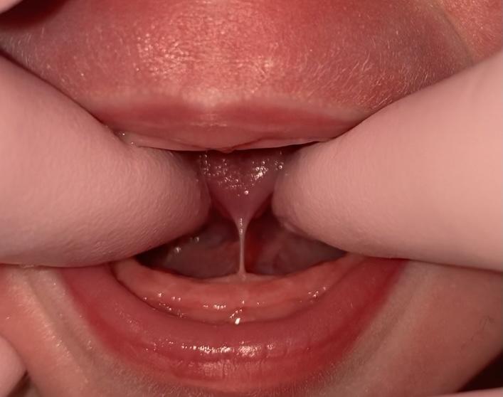 Tongue Tie, MD